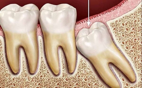 răng số 38, răng số 38 mọc lệch, răng số 38 là răng nào, nhổ răng số 38 hết bao nhiêu tiền, nhổ răng số 38, răng khôn số 38, vị trí răng số 38, nhổ răng khôn số 38