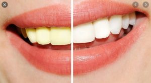 tẩy trắng răng có hại không, tẩy trắng răng có hại gì không, tẩy trắng răng có hại hay không